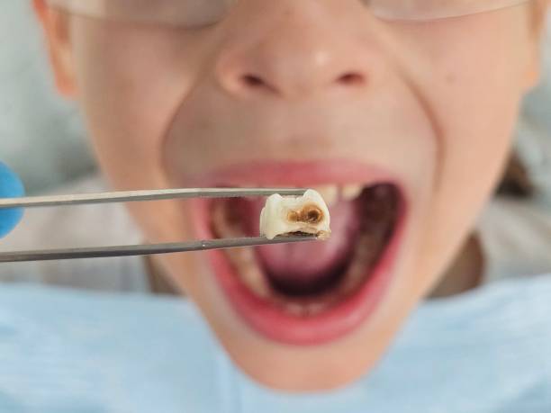 Best Emergency Dentist for Lost Fillings or Crowns in Sayville, NY